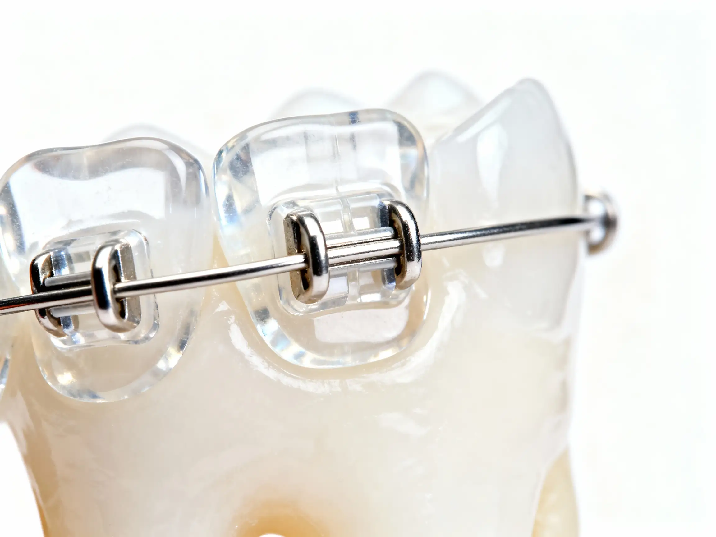 Brackets_transparentes_de_cerámica