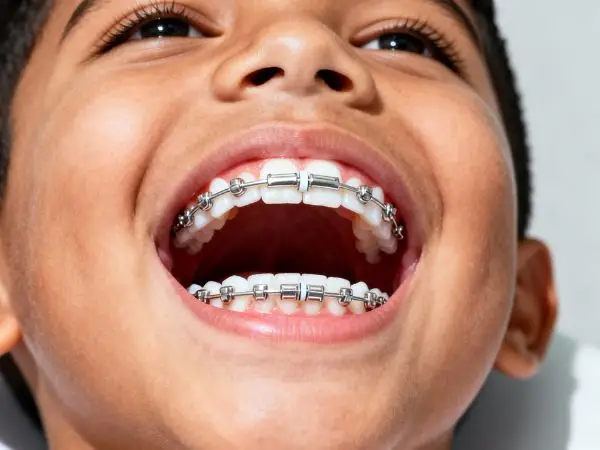 Expansor palatino niños ortopedia maxilar Ibagué