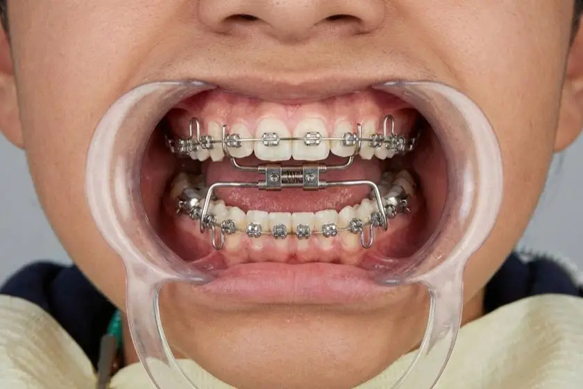 ortopedia-maxilar-niño-adulto
